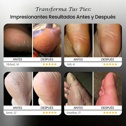 FootCare - Eliminador Eléctrico de Callos de los Pies